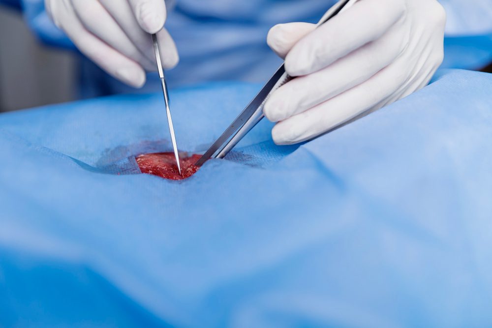 Appendectomy