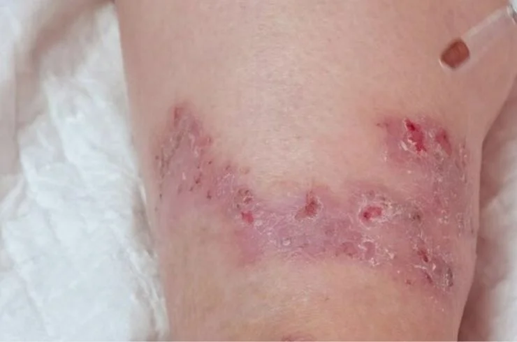 Diabetic wound management