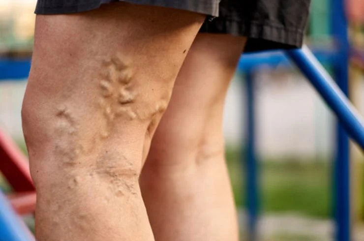 Varicose veins-2