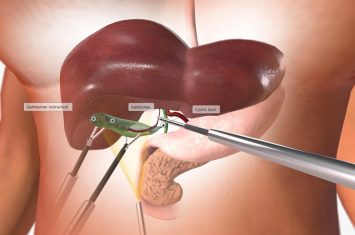 Cholecystectomy Cholecystectomy