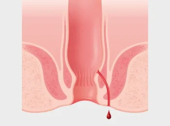 Fistulas-2 Fistulas-2