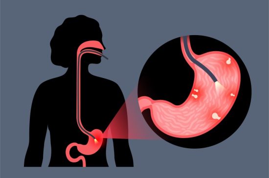 gastroscopy_13 gastroscopy_13